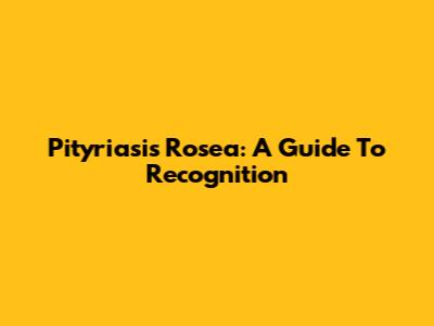 Pityriasis Rosea: A Guide To Recognition